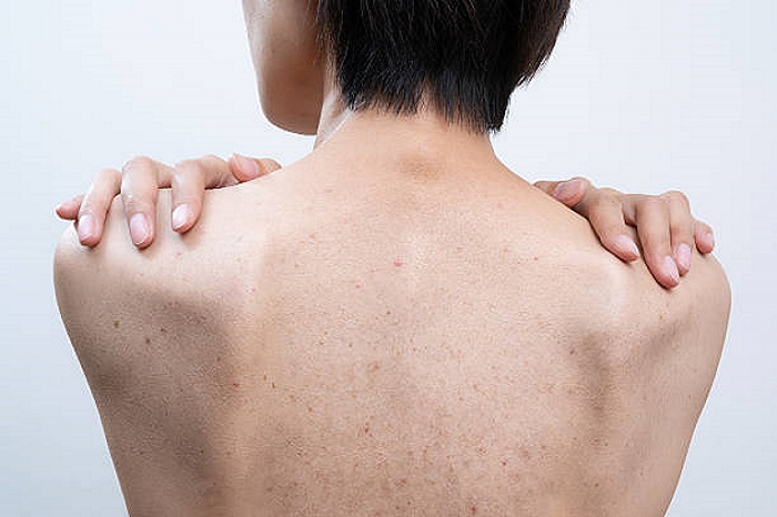 Back Acne Treatment